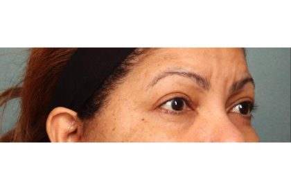 Blepharoplasty Before & After Patient #9018