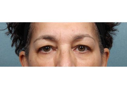 Blepharoplasty Before & After Patient #9016