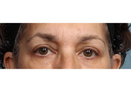 Blepharoplasty Before & After Patient #9016
