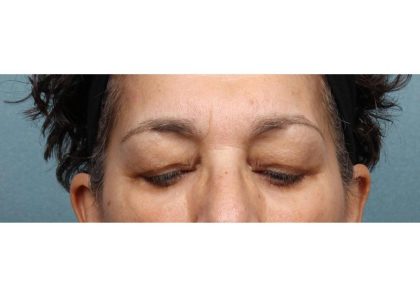 Blepharoplasty Before & After Patient #9016