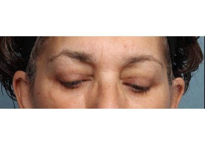 Blepharoplasty Before & After Patient #9016