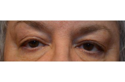 Blepharoplasty Before & After Patient #9015