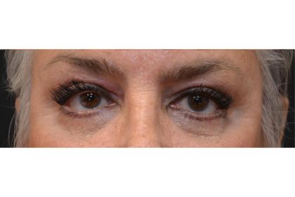 Blepharoplasty Before & After Patient #9015
