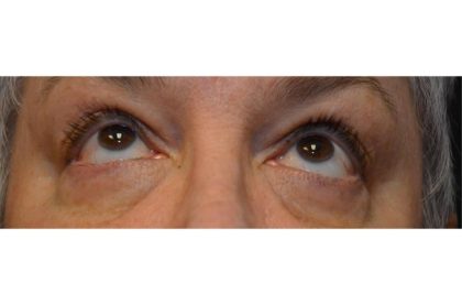 Blepharoplasty Before & After Patient #9015
