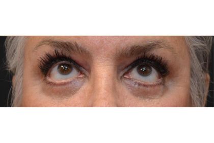 Blepharoplasty Before & After Patient #9015