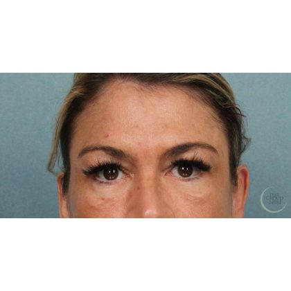 Blepharoplasty Before & After Patient #8985