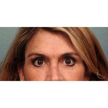 Blepharoplasty Before & After Patient #8985