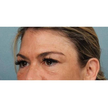 Blepharoplasty Before & After Patient #8985