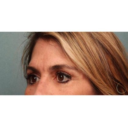 Blepharoplasty Before & After Patient #8985