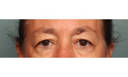 Blepharoplasty Before & After Patient #9114