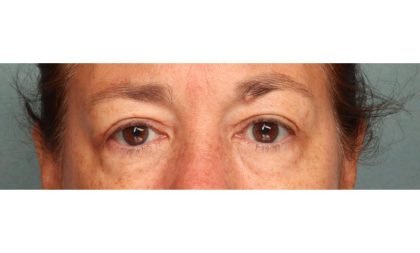 Blepharoplasty Before & After Patient #9114