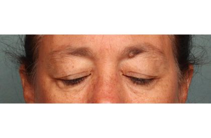 Blepharoplasty Before & After Patient #9114