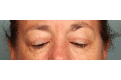 Blepharoplasty Before & After Patient #9114