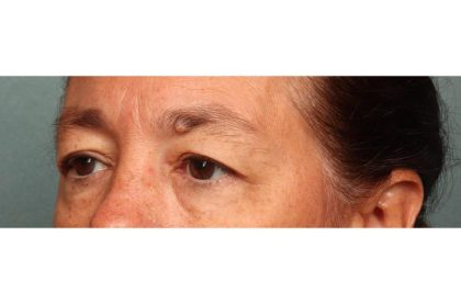 Blepharoplasty Before & After Patient #9114