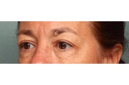 Blepharoplasty Before & After Patient #9114