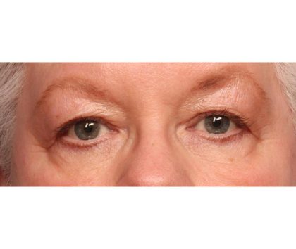 Blepharoplasty Before & After Patient #9070