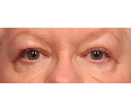 Blepharoplasty Before & After Patient #9070