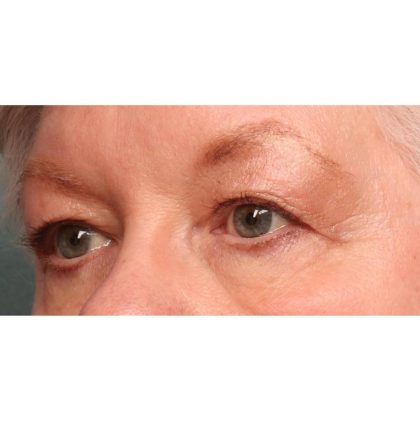 Blepharoplasty Before & After Patient #9070