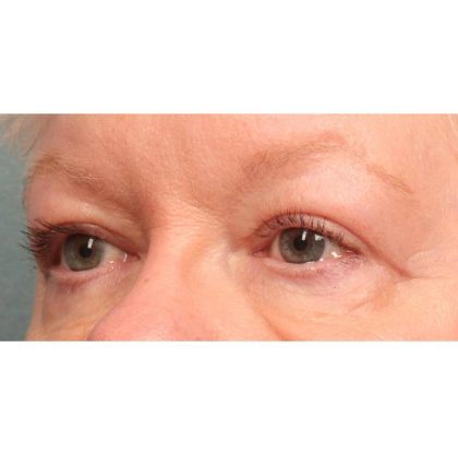Blepharoplasty Before & After Patient #9070