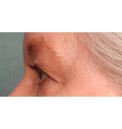 Blepharoplasty Before & After Patient #9070