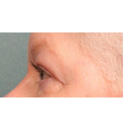 Blepharoplasty Before & After Patient #9070