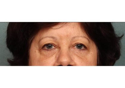 Blepharoplasty Before & After Patient #9068