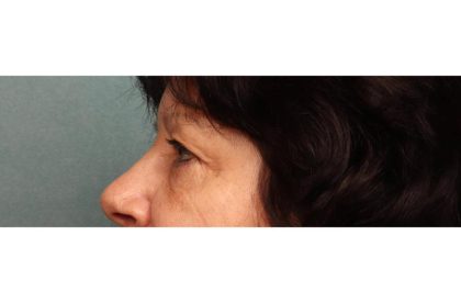 Blepharoplasty Before & After Patient #9068