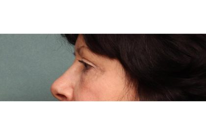 Blepharoplasty Before & After Patient #9068