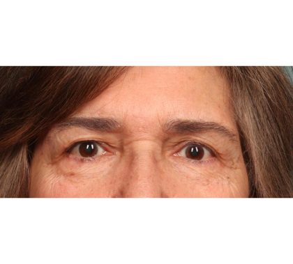 Blepharoplasty Before & After Patient #9066