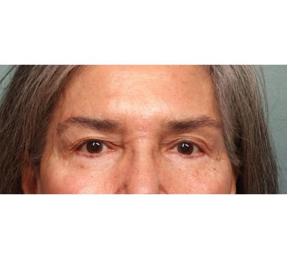 Blepharoplasty Before & After Patient #9066