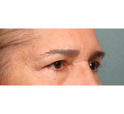 Blepharoplasty Before & After Patient #9066