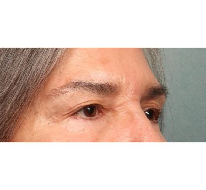 Blepharoplasty Before & After Patient #9066