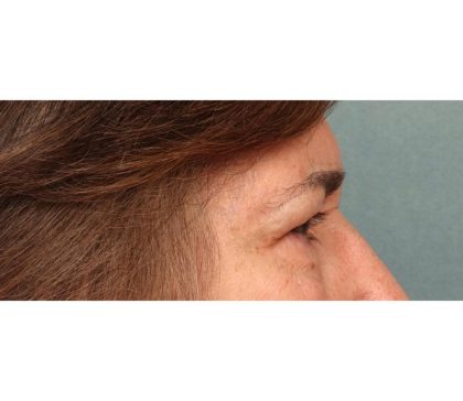 Blepharoplasty Before & After Patient #9066