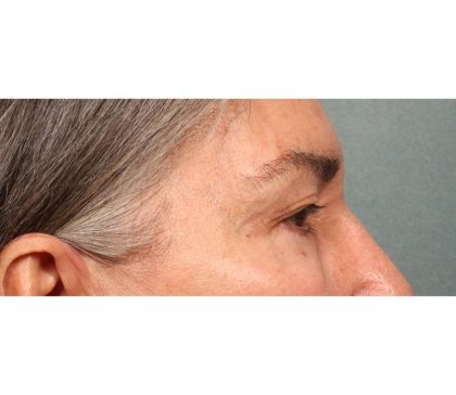 Blepharoplasty Before & After Patient #9066