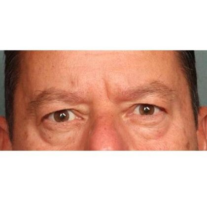 Blepharoplasty Before & After Patient #9065