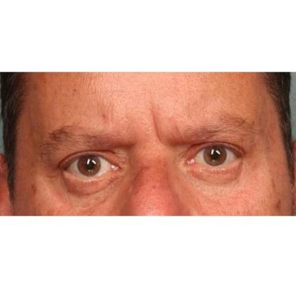 Blepharoplasty Before & After Patient #9065