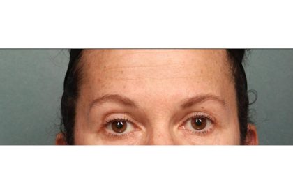 Botox Before & After Patient #9083