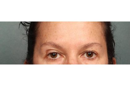 Botox Before & After Patient #9083