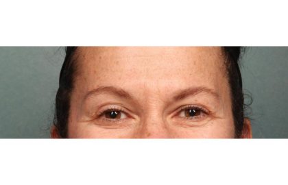 Botox Before & After Patient #9083