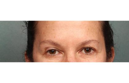 Botox Before & After Patient #9083