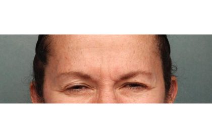 Botox Before & After Patient #9083