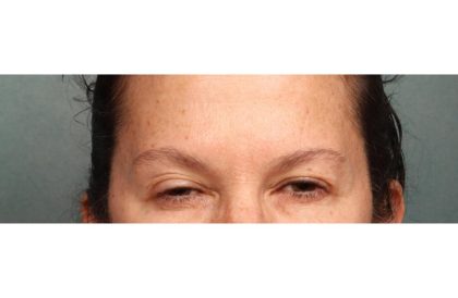 Botox Before & After Patient #9083