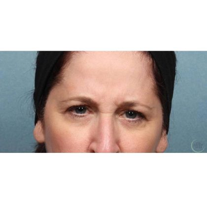 Botox Before & After Patient #9086