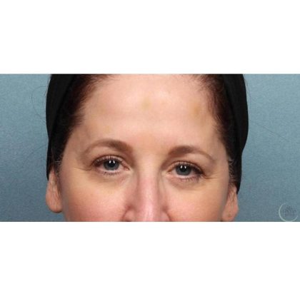 Botox Before & After Patient #9086