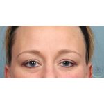 Botox Before & After Patient #9087