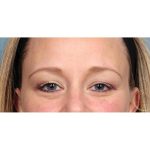 Botox Before & After Patient #9087