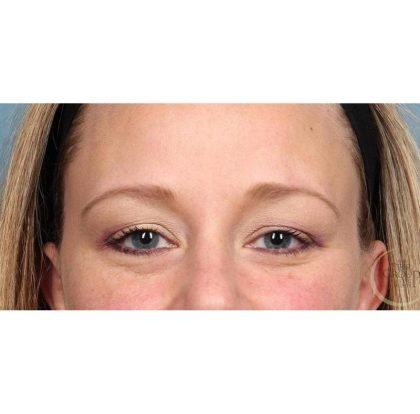 Botox Before & After Patient #9087