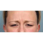 Botox Before & After Patient #9087