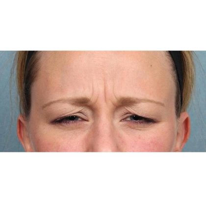 Botox Before & After Patient #9087