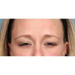 Botox Before & After Patient #9087